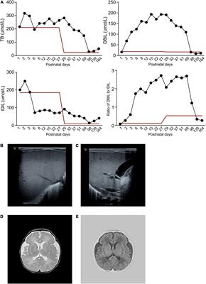 Novel Compound Heterozygous PKLR Mutation Induced Pyruvate Kinase Deficiency With Persistent Pulmonary Hypertension in a Neonate: A Case Report